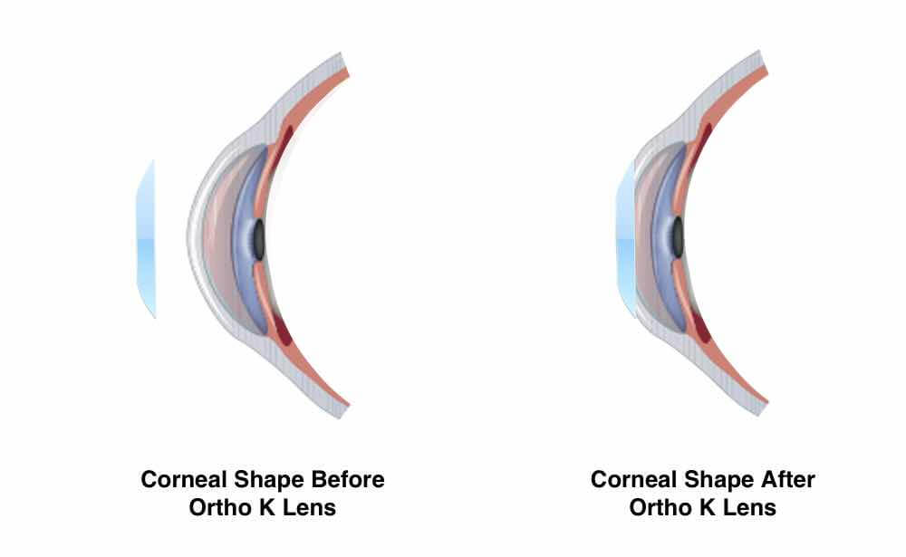 Ortho K Contact Lens Reshaping